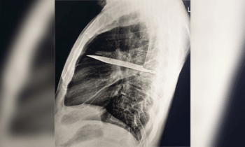 Fue al médico por una infección. Descubrieron que tenía cuchillo clavado en el pecho durante 8 años