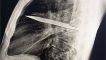 Chest X-ray